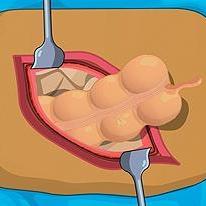 Operate Now: Appendix Surgery