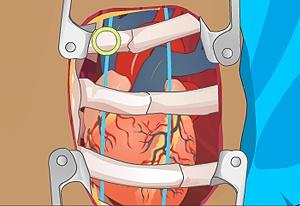 CIRURGIA NO CORAÇÃO - OPERATE NOW 